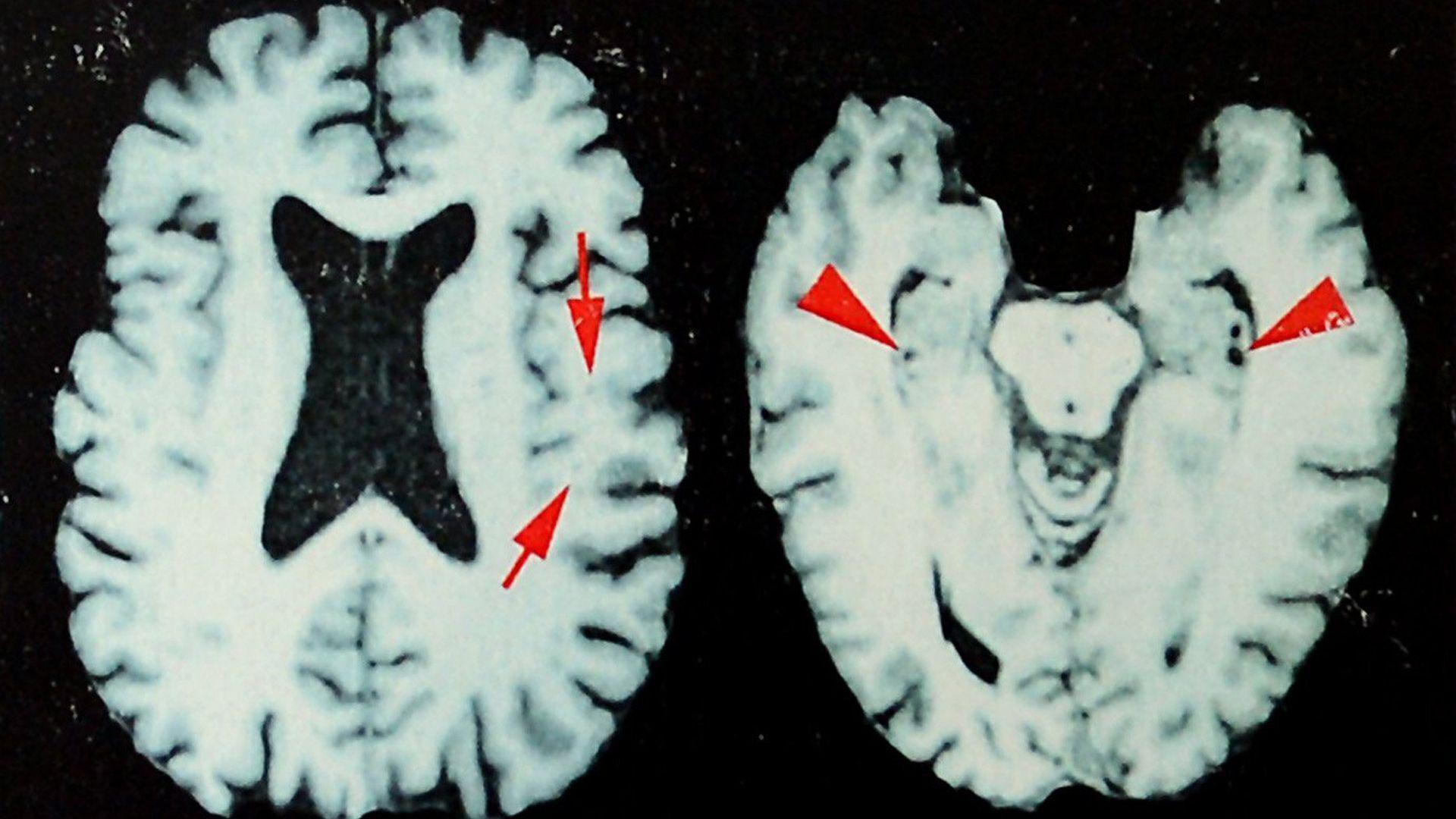 Deaths of NFL Players Reveal Up to 98% Risk of Brain Disease