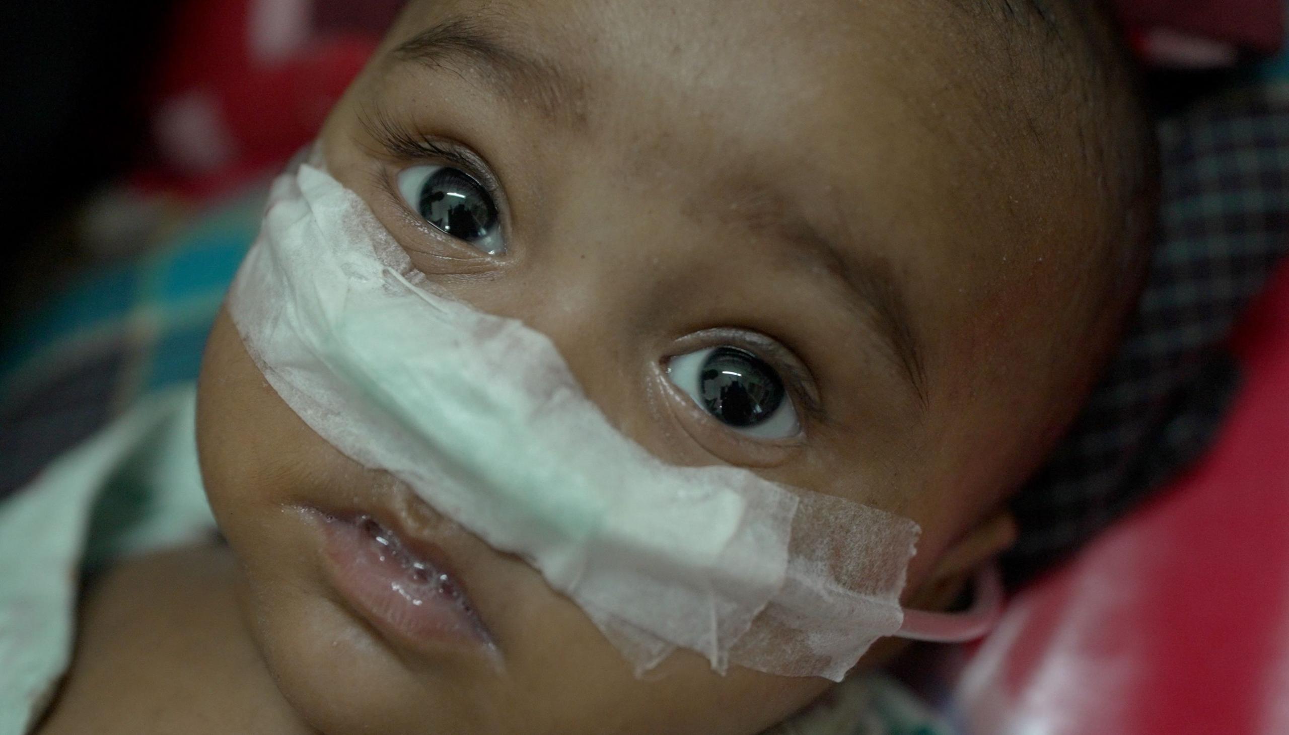 Bangladesh Faces a Deadly Measles Backlash After Years of Success